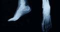 Foot xray Royalty Free Stock Photo