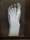 Foot xray showing soft tissue gas in patient with necrotizing fasciiitis