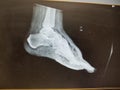 Foot xray showing soft tissue gas in patient with necrotizing fasciiitis