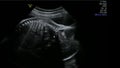 Footage of Blood Flow in the Umbilical Cord in Mothers Womb Ultrasound Scan