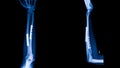 Forearm fracture with compression plate.Fixation of fracture in blue tone.