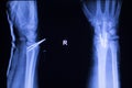 Forearm orthopedic implant xray scan