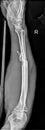 Adult Forearm Fractures lateral view radiograph