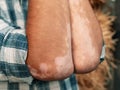 Forearms of a man with vitiligo