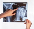 Forefinger pointing to trauma at arm X-ray image. Acromion, acromial end fracture. Doctor showing shoulder, clavicle Royalty Free Stock Photo