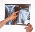 Forefinger pointing to trauma at shoulder, clavicle X-ray image. Acromion, acromial end fracture. Arm injury. Health