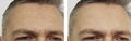 Forehead man wrinkles before and after cosmetology, effect Royalty Free Stock Photo