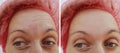 Forehead woman wrinkles before and after cosmetic procedures removal