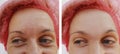 Forehead woman wrinkles results before and after cosmetic procedures removal