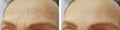 Forehead women wrinkles before and after procedures