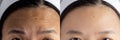 Forehead wrinkles problem. pictures compared effect Before and After treatment for forehead wrinkles skin problem in woman