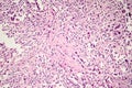 Foreign body granuloma