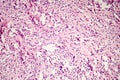 Foreign body granuloma