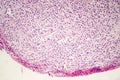 Foreign body granuloma