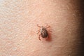 Forest mite on the skin. wood tick Royalty Free Stock Photo