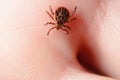 Forest mite on the skin. wood tick Royalty Free Stock Photo