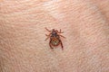 Forest mite on the skin. wood tick Royalty Free Stock Photo