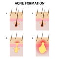 Formation of acne Royalty Free Stock Photo