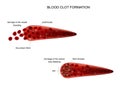 Formation of a blood clot Royalty Free Stock Photo