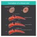 Formation of a blood clot.