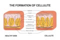 The formation of cellulite. Cellulite occurs in most females and rarely in males. Vector diagram. Comparative Royalty Free Stock Photo