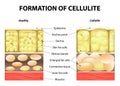 Formation of cellulite Royalty Free Stock Photo