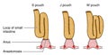 Formation of pouch following colostomy