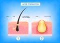 Formation of skin acne or pimple. Accumulation of dead cells and inflammation associated with pimples