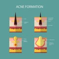 Formation of skin acne or pimple. The sebum in the Royalty Free Stock Photo