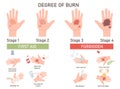 Degree of skin burn infographic poster with first aid and forbidden action vector illustration Royalty Free Stock Photo