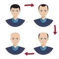 Four stages of hair loss for men.