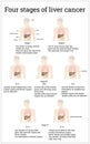 Four stages of liver cancer