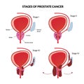 Four stages of prostate cancer