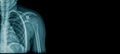 Shoulder x-ray x-ray Royalty Free Stock Photo