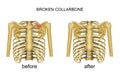 Fracture of the clavicle. recovery