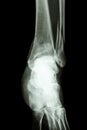 Fracture distal tibia and fibula (leg's bone)