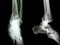 Fracture distal tibia and fibula (leg's bone)