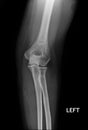 Fracture Elbow, forearm x-rays image showing plate and fixation