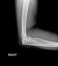 Fracture Elbow, forearm x-rays image showing plate and fixation