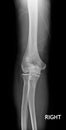 Fracture Elbow, forearm x-rays image showing plate and fixation