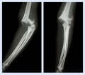 Fracture elbow (Left image : side position , Right image : front position)