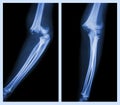 Fracture elbow (Left image : side position , Right image : front position)