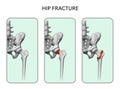 Fracture of the femoral neck.