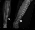 Fracture of fibular and tibial bone