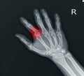 Fracture index proximal phalanx showing x-ray hand.