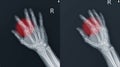 Fracture index proximal phalanx showing x-ray hand.