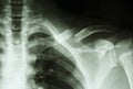Fracture left clavicle Royalty Free Stock Photo
