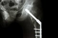 Fracture neck of femur(thigh's bone). patient was operated and f Royalty Free Stock Photo