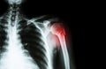 Fracture at neck of humerus ( arm bone ) ( film x-ray left shoulder and blank area at right side ) Royalty Free Stock Photo