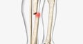 A fracture, often referred to as a broken bone, is an acute injury that causes a partial or complete break through bone